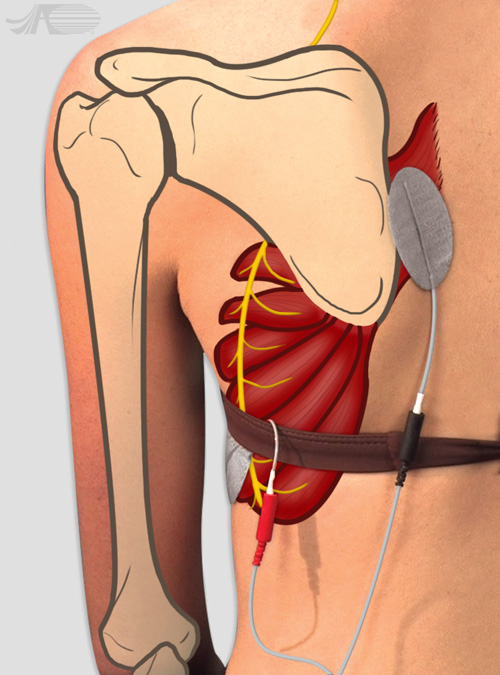 http://www.axelgaard.com/Images/EducationApp/ElectrodePlacement/Illus_ScapularRetraction.jpg