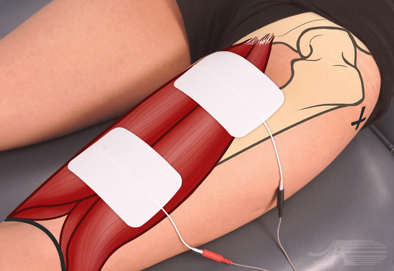 Electrode Placement for Muscle Stimulation