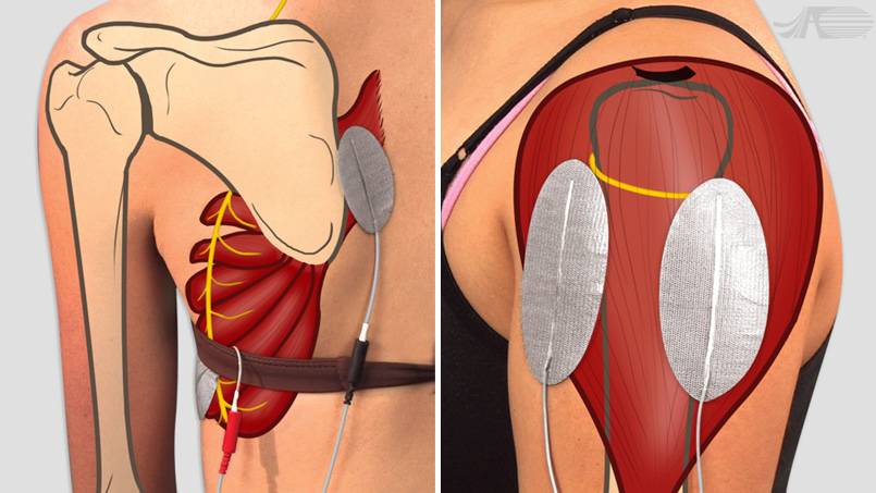 Later anterior deltoid head Electrode Placement for Compex Muscle