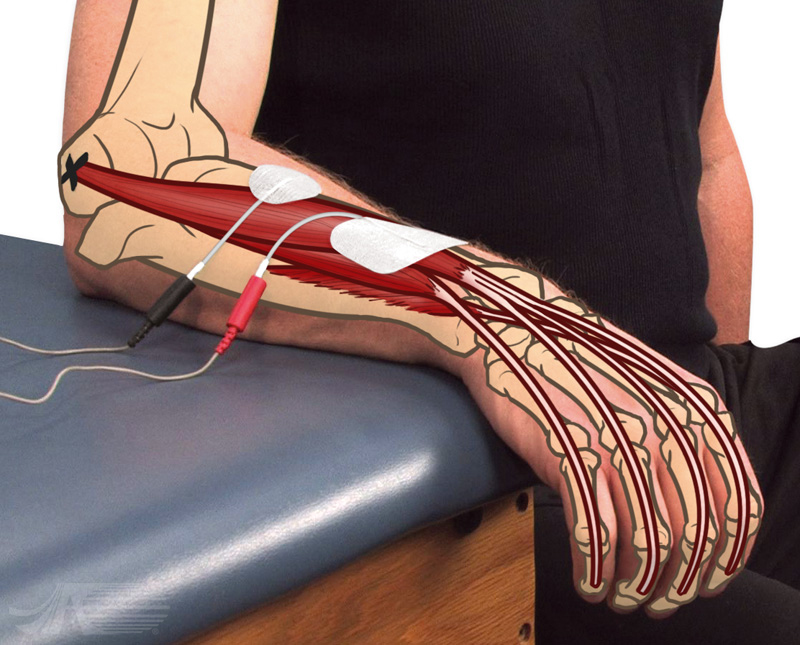 Position of the electrical muscle stimulation electrodes placed